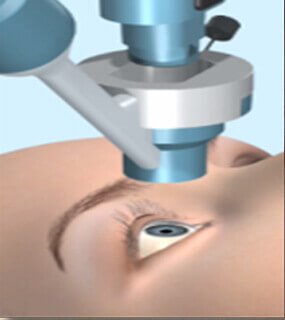 Lasik Surgery Treatment in Agra