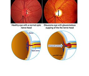 Lasik Surgery Treatment in Agra