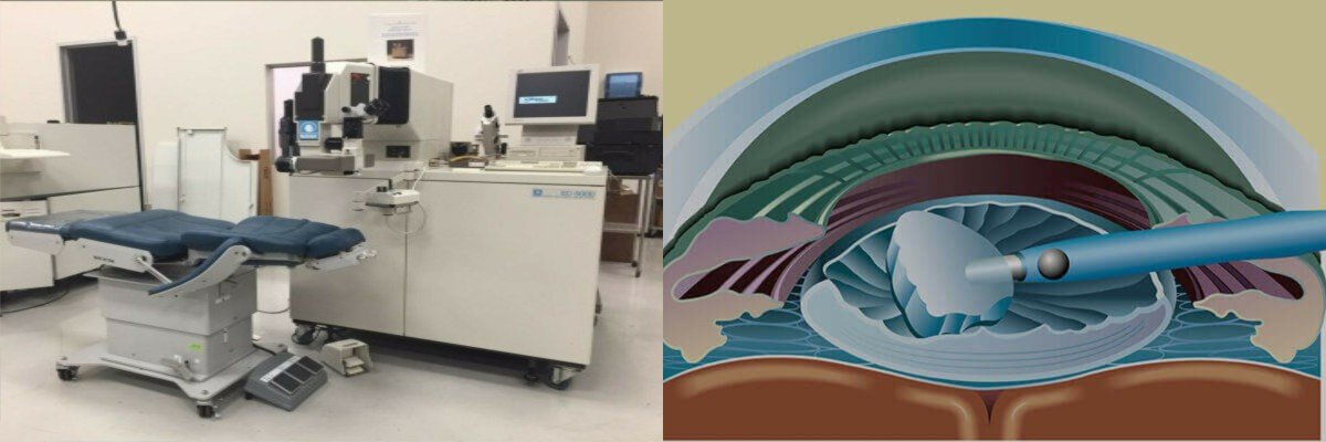 Lasik Surgery in Agra